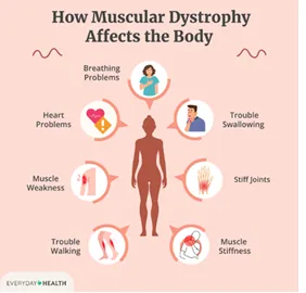 Neuromuscular Disorders (Special Focus) image 1