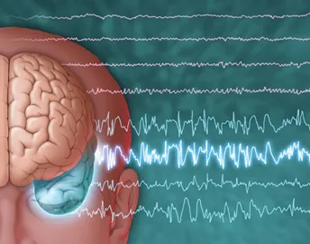 Epilepsy and Seizure Disorders image 1