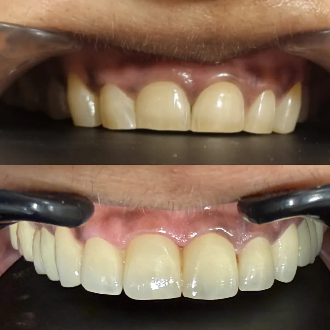 Full Mouth Rehabilitation image 2
