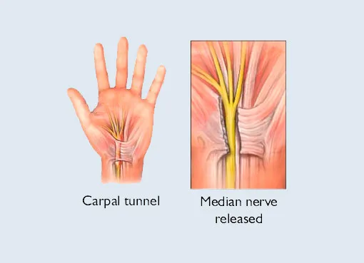 Carpal Tunnel Release image 1
