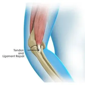 Tendon and Ligament Reconstruction image 1