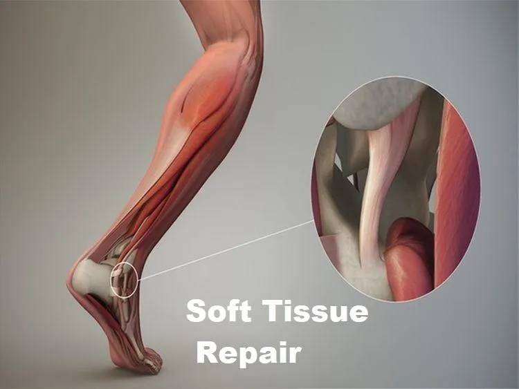 Soft Tissue Repair Treatment image 1