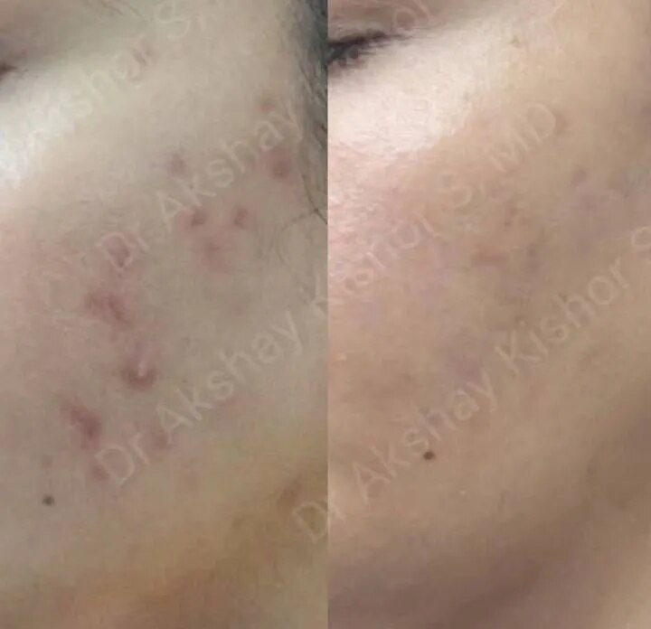 Acne And Acne Scars Marks Treatment  image 1