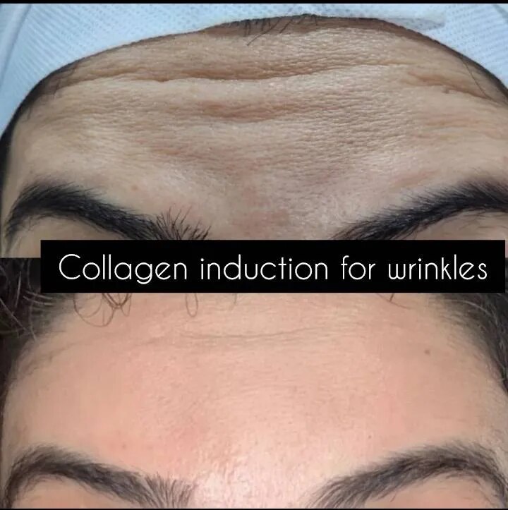 Wrinkles Treatment image 1