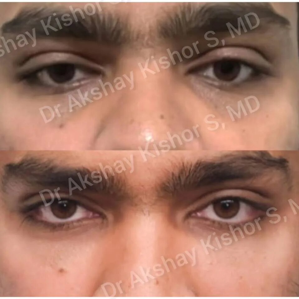 Undereye Hollow And Dark Circles Treatment image 1