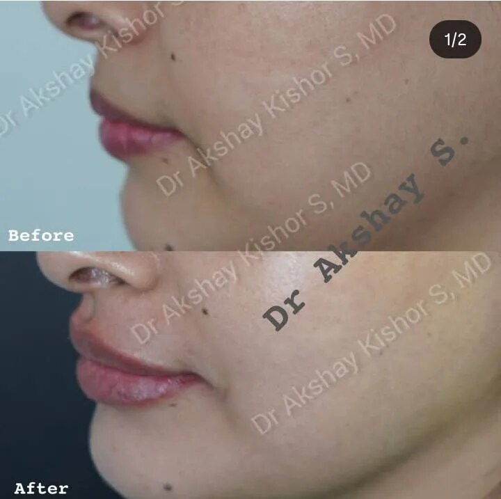 Lip Fillers Treatment image 1
