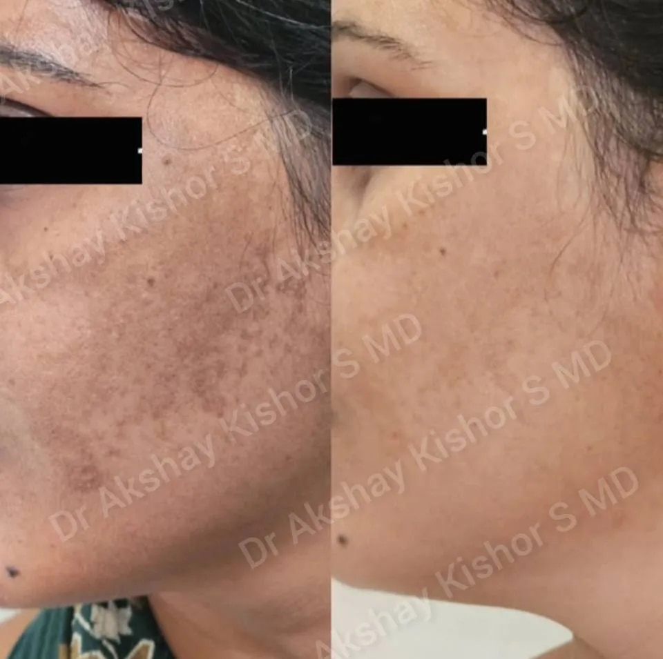 Melasma Treatment  image 1