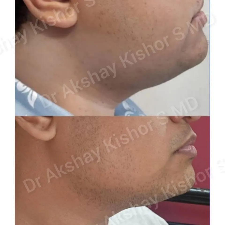Non Surgical Double Chin Reduction image 1