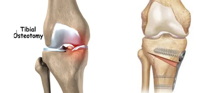 Osteotomy and deformity correction image 1