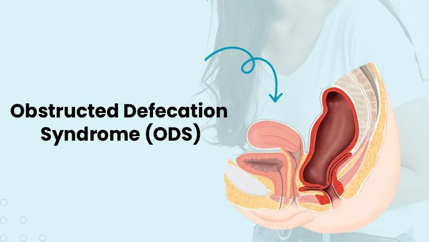 Obstructed Defecation Syndrome image 1