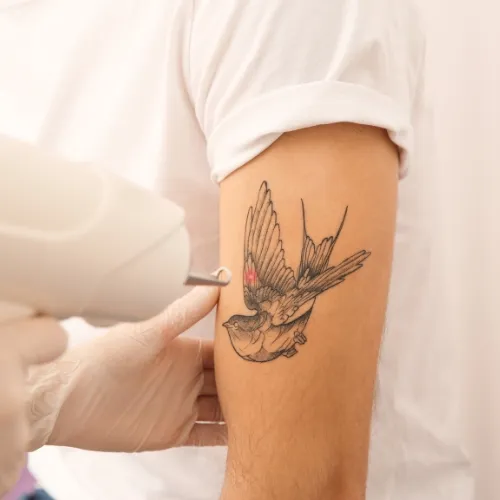 Laser Tattoo Removal image 1