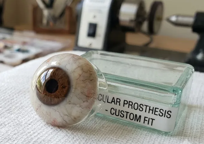 Ocular Prosthesis image 1