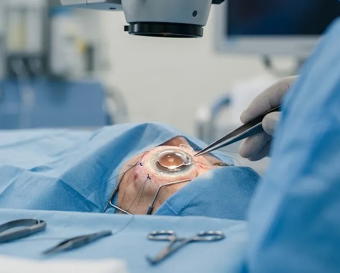 Secondary IOL (SF-IOL) image 1