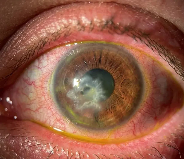 Cornea Ulcer Treatment image 1