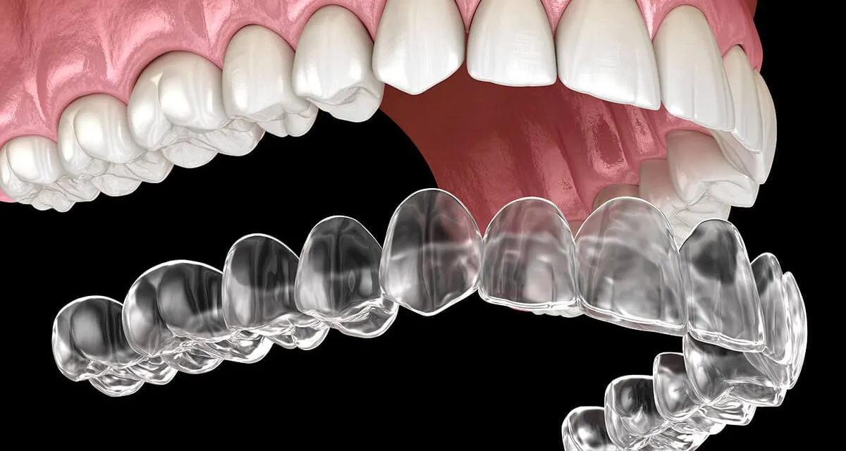 Aligners Treatment image 1