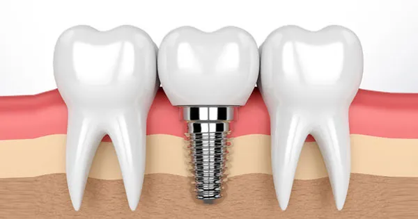 Corticobasal Implants image 1