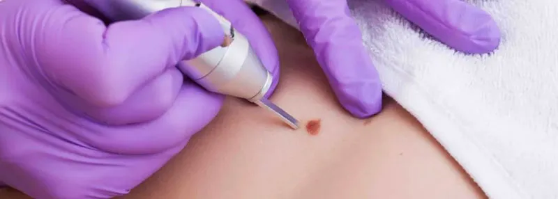 Removal of Warts, Moles, Molluscum Contagiosum image 1