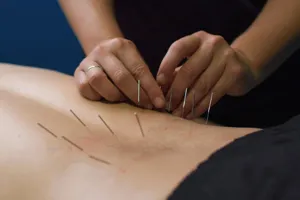 Acupuncture/Dry Needling image 1