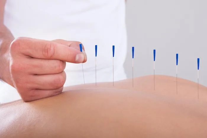 Acupuncture/Dry Needling image 2