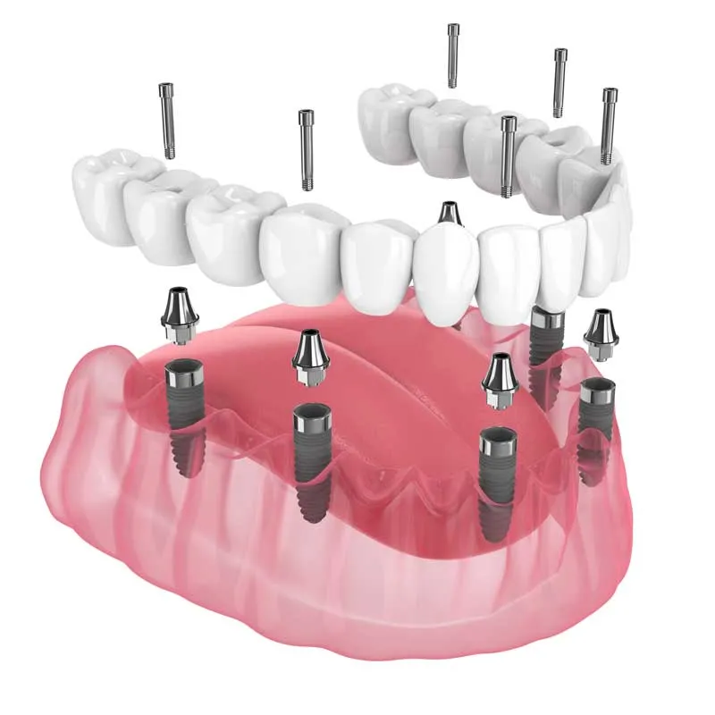 Full Arch Implants image 1