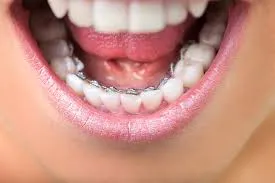 Lingual Braces Treatment image 1