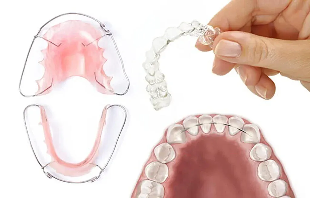 Retainers Treatment image 1