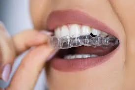 Aligners Treatment image 1