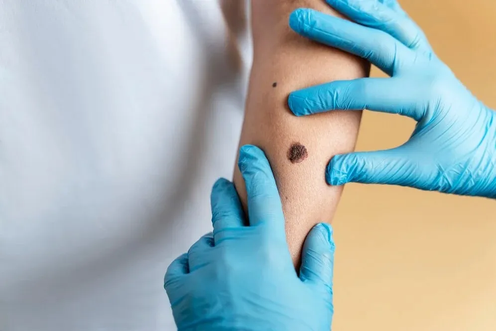 Warts/Mole Removal Treatment in Aundh, Sanghvi, Baner, Balewadi, Pune image 1