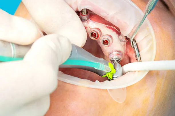 Dental Implant Surgeries image 1