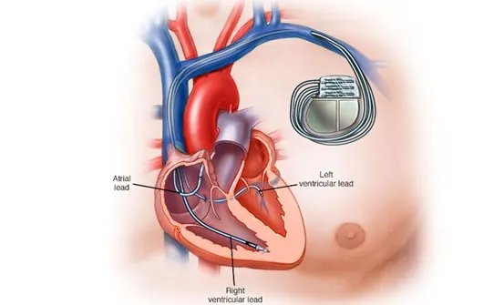 Cardiac Resynchronization Therapy Defibrillator (CRT-D) image 1