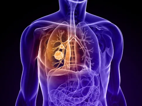 Oral Cancer Treatment image 1