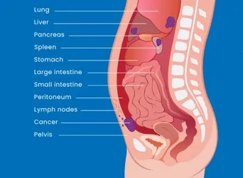 Peritoneal Cancer image 1
