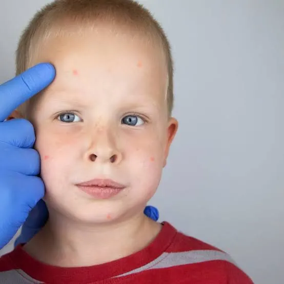 Birthmarks & Pigmentation Disorders image 1