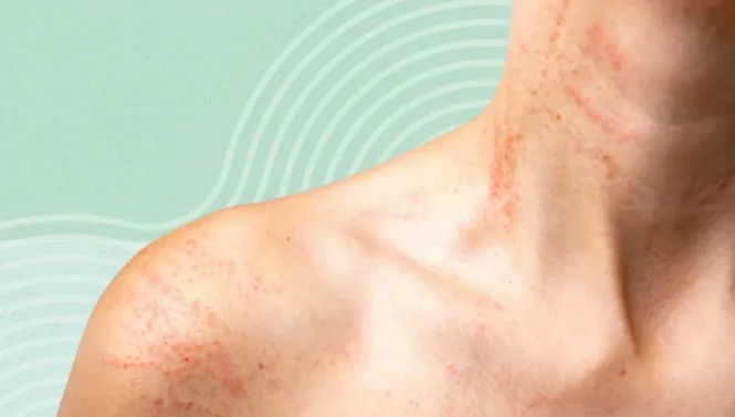 Allergic Skin Conditions & Rashes image 1
