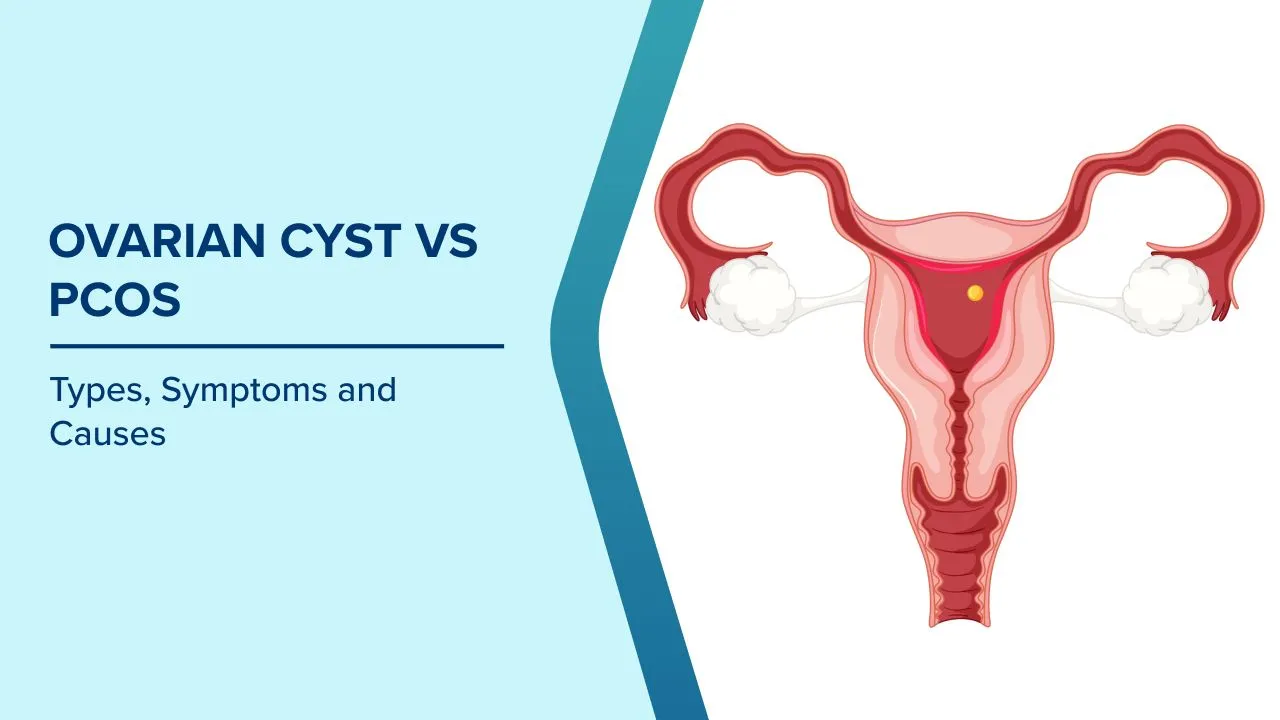 Management of PCOS and Ovarian Cysts image 1