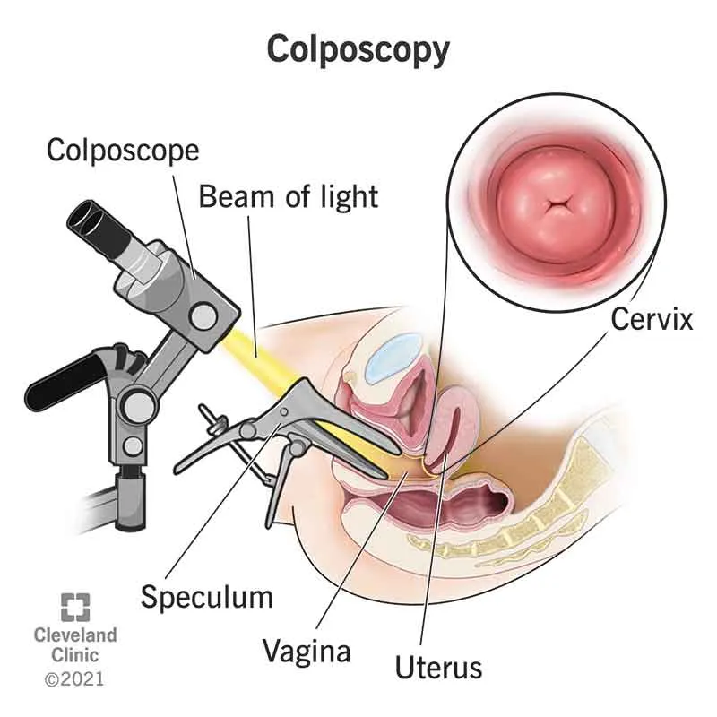 Colposcopy Treatment image 1