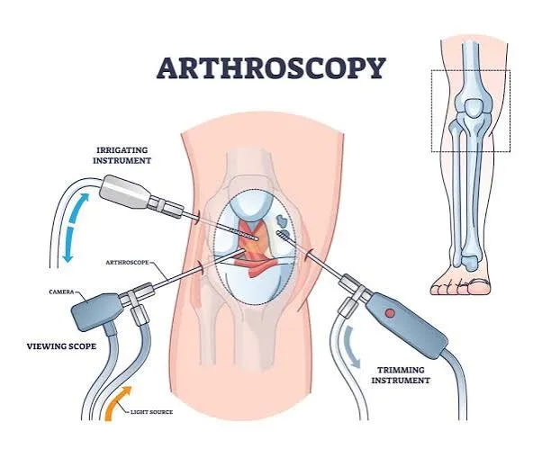 Arthroscopy Procedures  image 1