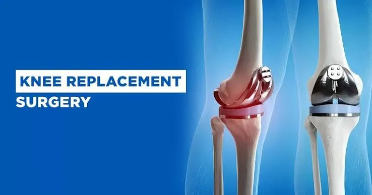 Knee Replacement Surgery image 1