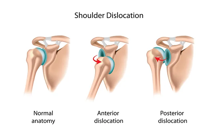 Shoulder Instability/Dislocation image 1