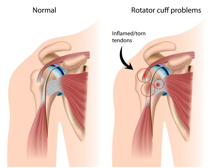 Rotator Cuff Injury/Tear image 1