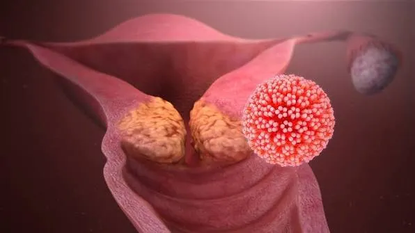 Fertility-Sparing Cancer Surgeries image 1