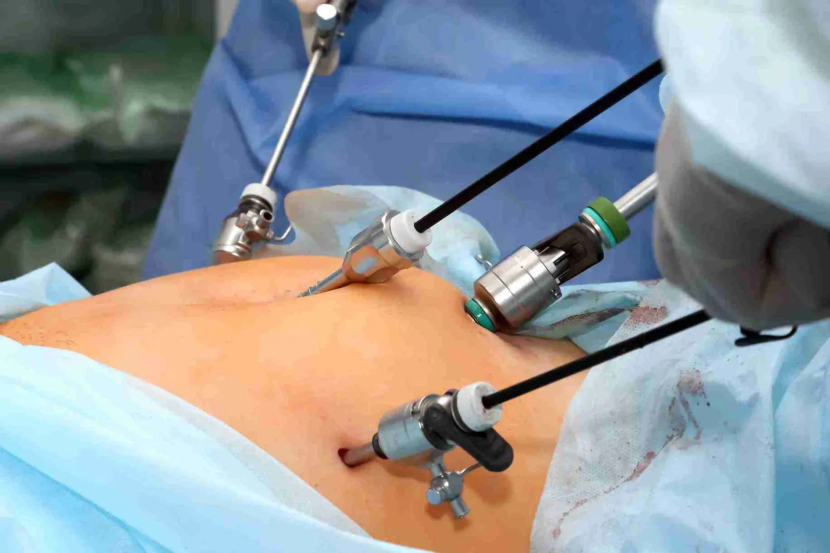 Laparoscopic Gynecology Surgeries image 1