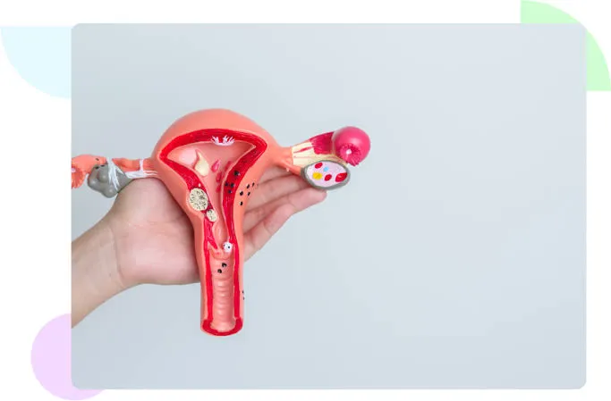 PCOS & Fibroid Management image 1