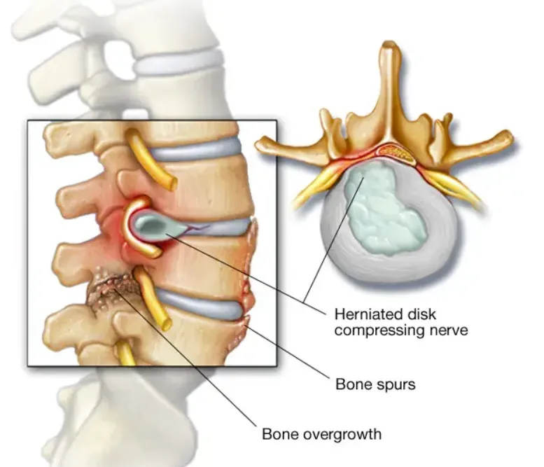Spinal Stenosis image 1