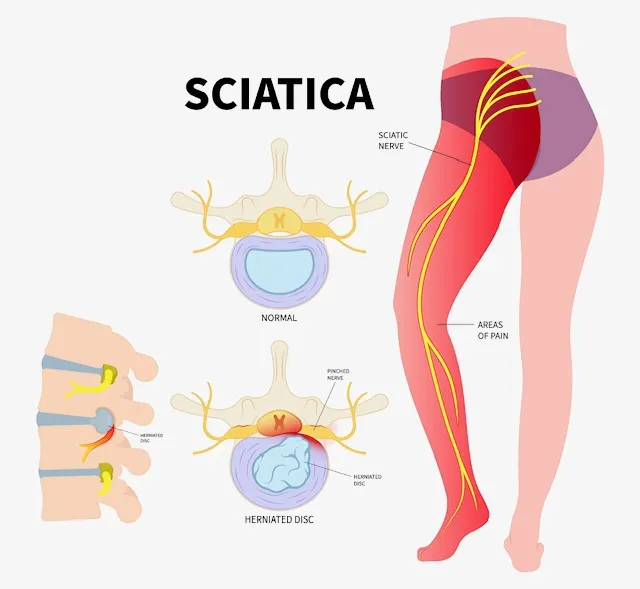 Sciatica image 1