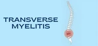 Transverse Myelitis image 2