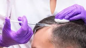PRP therapy for hair growth  image 1