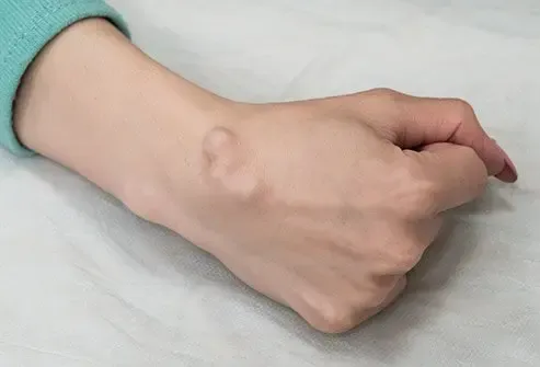 Ganglion Cyst Removal image 1