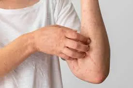Skin allergy and infection treatment image 1