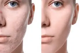 Acne and acne scar treatment image 1